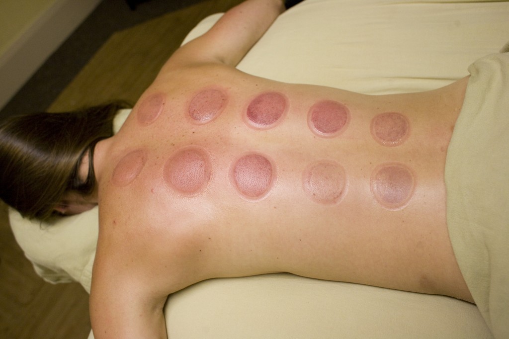 Cupping